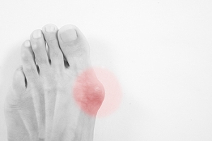 Easy to Spot a Bunion