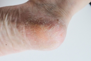 Cracked Heels Can Be Unsightly and Painful