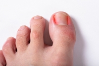 Causes and Risks of Ingrown Toenails