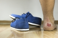 Common Causes of Blisters in Runners