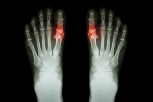 How Podiatrists Can Test for Gout